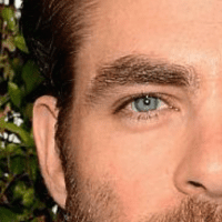 Haartransplantatie in Turkije haar behandelingen - Haartransplantatie in Turkije